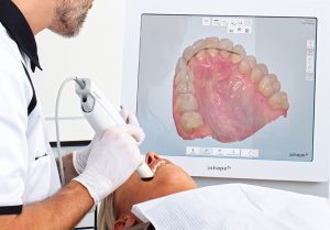 image d'une empreinte dentaire optique 